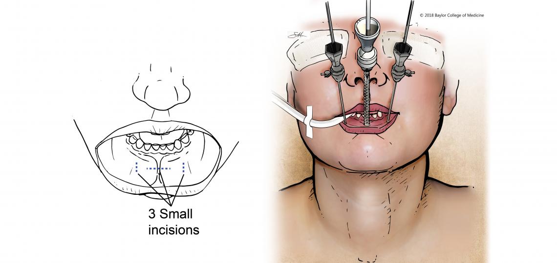 Scarless Thyroid And Parathyroid Surgery