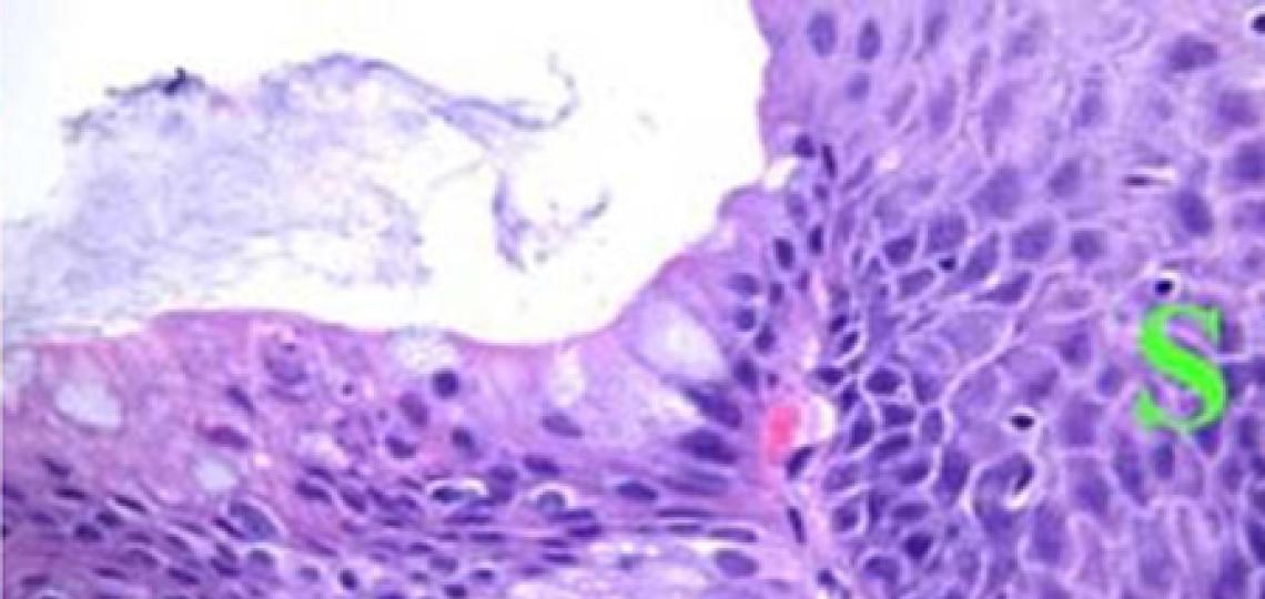 Barrett's metaplasia under the microscope