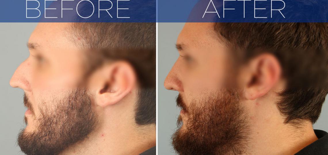 Before and After Nose Surgery