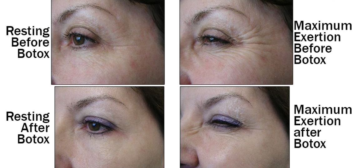 Botox for Wrinkles | Baylor Medicine Botox for Wrinkles | Baylor Medicine