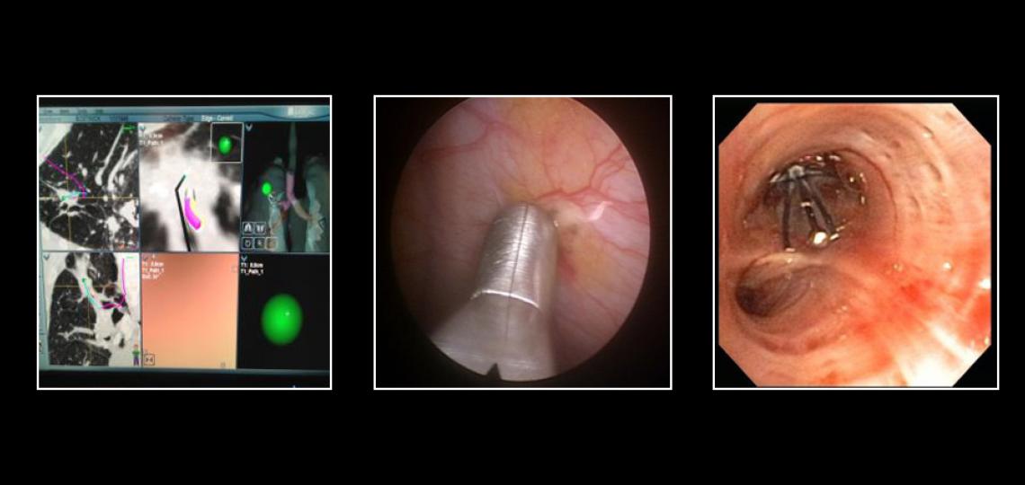 Navigational bronchoscopy (left). Thoracoscopic pleural biopsy (middle). Endobrochial valve for persistent air-leak (right).
