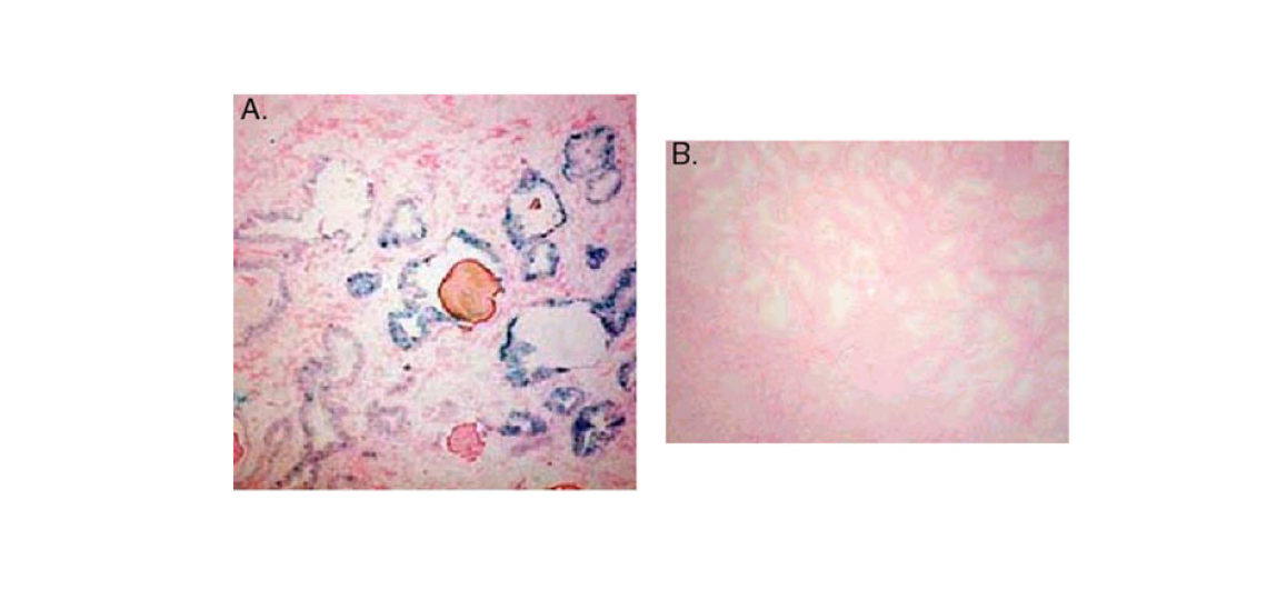 Cellular senescence and benign prostatic hyperplasia (BPH)
