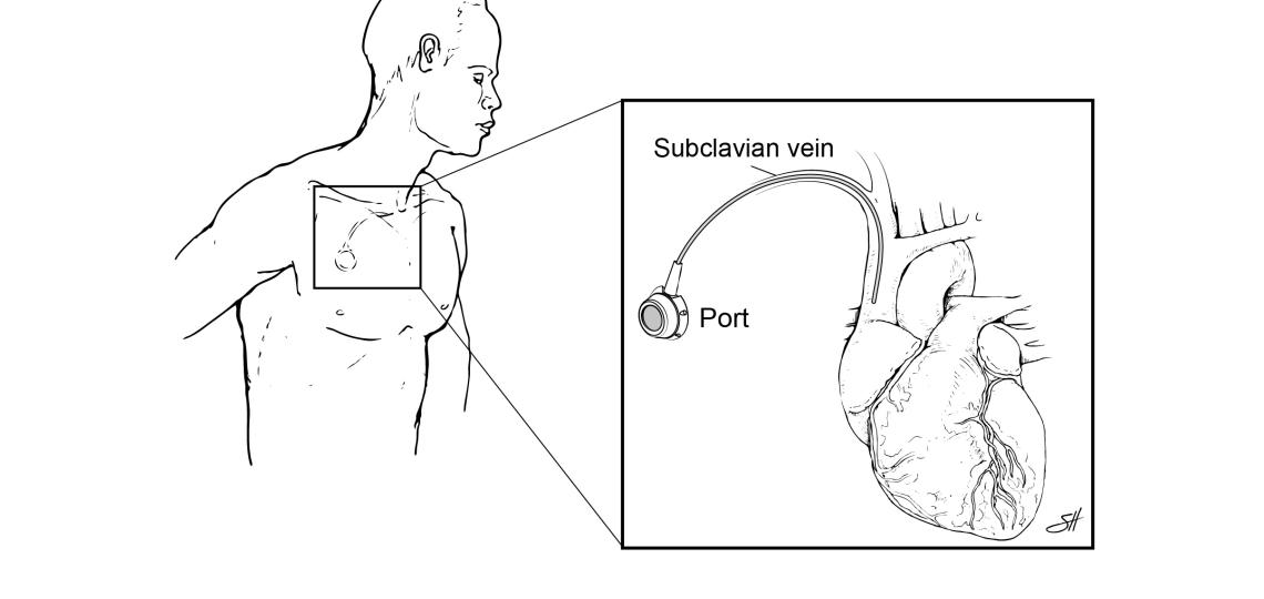 Central venous access. Credit Scott Holmes