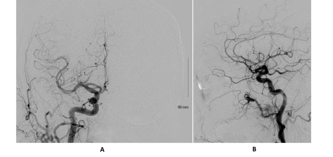 AP (A) and lateral (B) view of a right common carotid injection (normal angiogram)