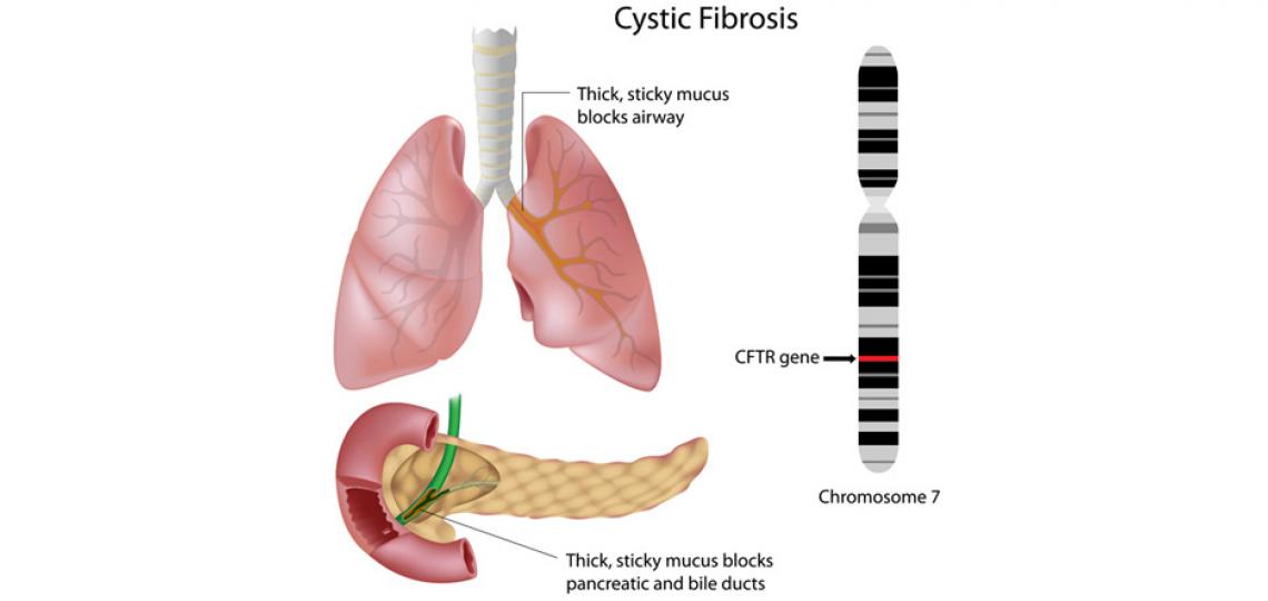 Cystic fibrosis results in a thick, sticky mucus that blocks airways and pancreatic and bile ducts.