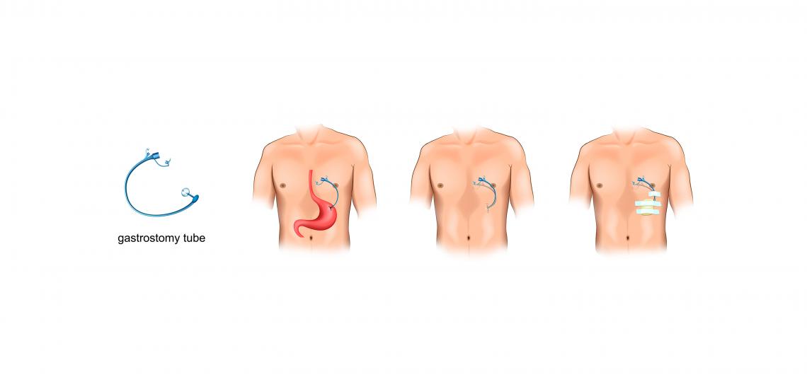 Percutaneous endoscopic gastrostomy (PEG)