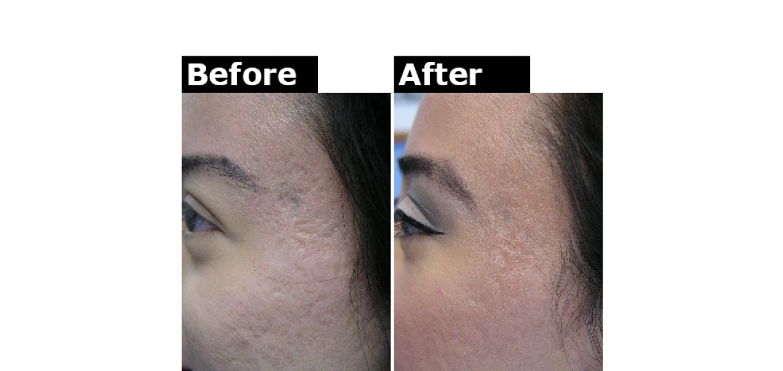 Derm Laser Fraxel