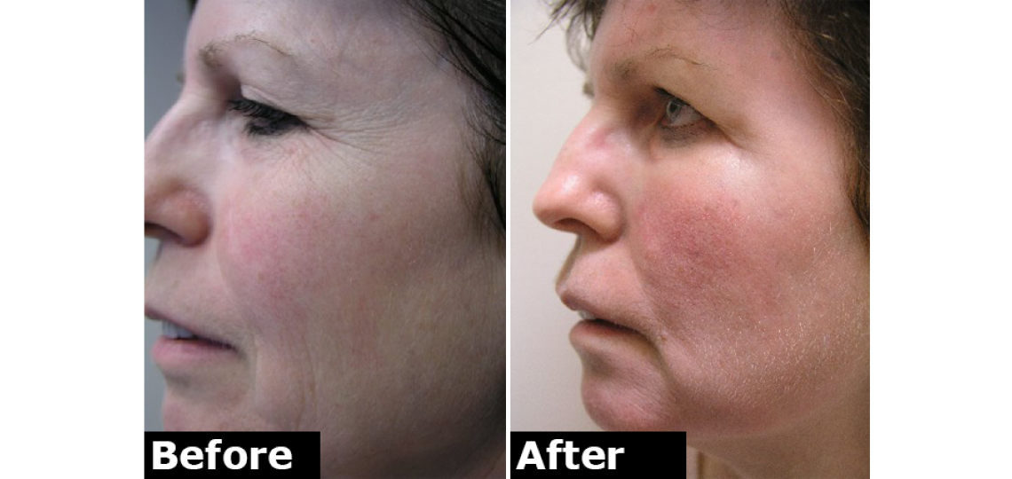 Derm Laser Fraxel