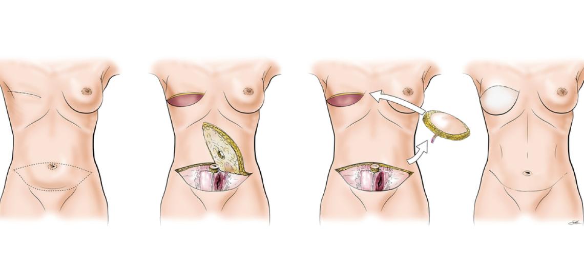 Illustration of a DIEP Flap reconstruction