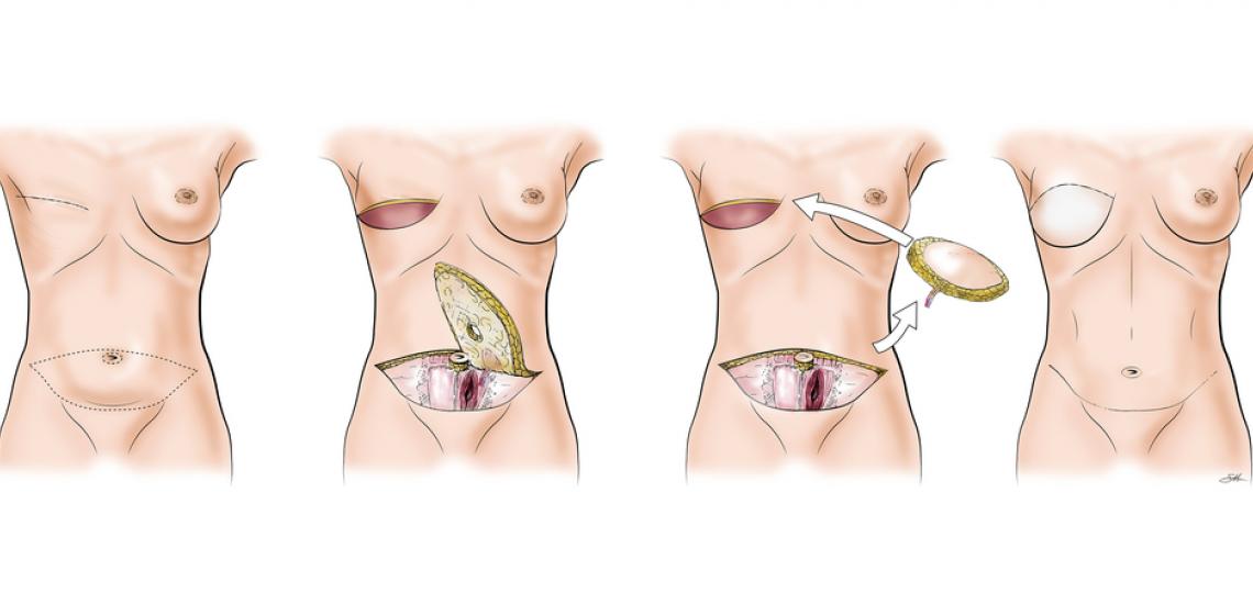 Illustration of a DIEP Flap reconstruction