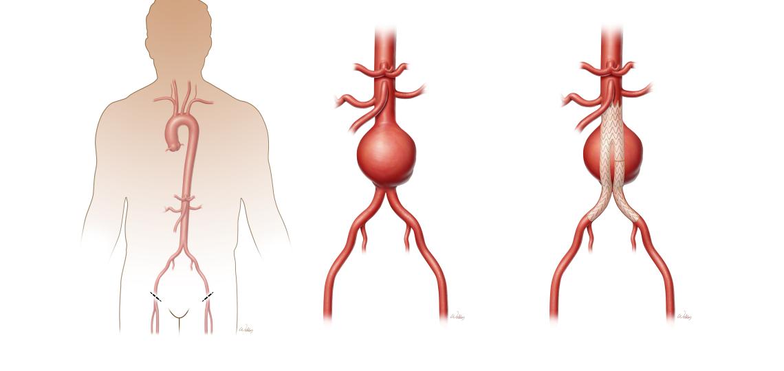 Endovascular repair of abdominal aortic aneurysm.