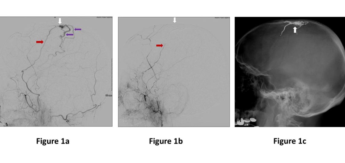 Figure 1. Dural Arteriovenous Fistulas