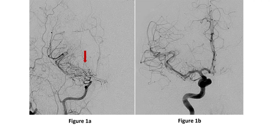 Figure 1. Angiogram for moyamoya disease