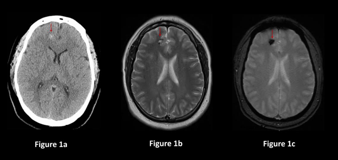 Figure 1. Cavernous Malformations