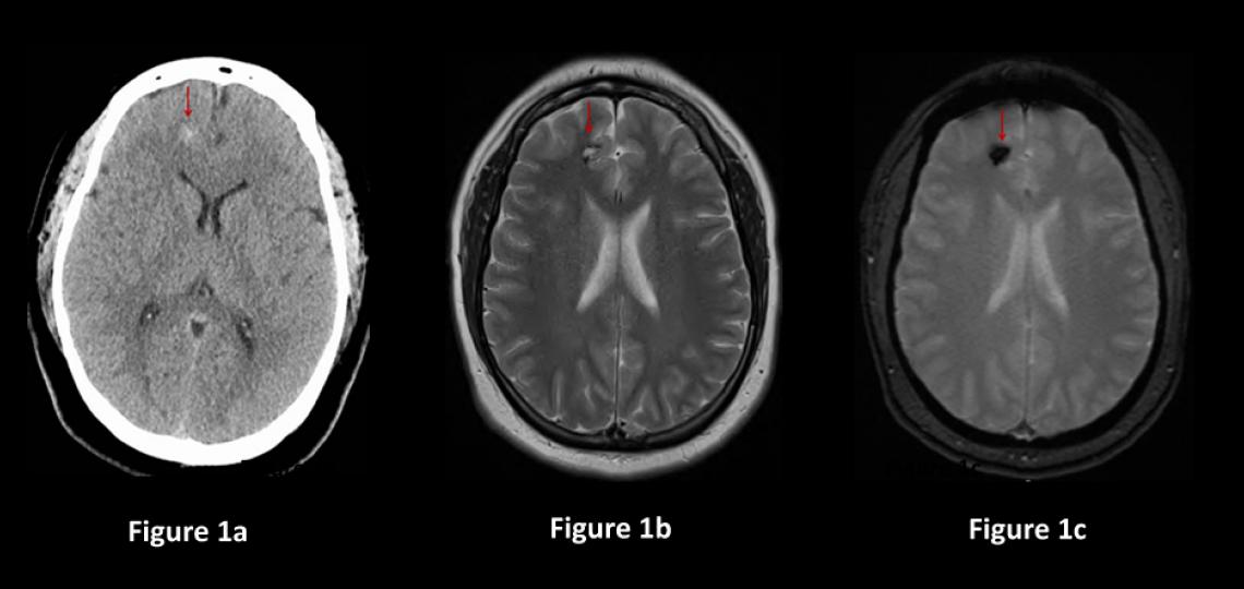 Figure 1. Cavernous Malformations