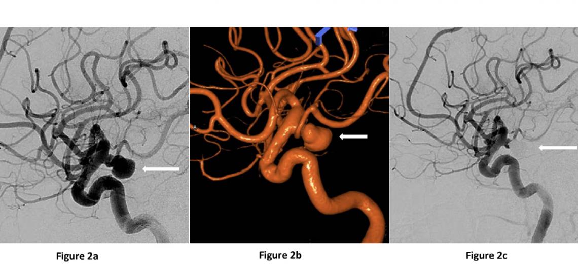 Brain Aneurysms Baylor Medicine
