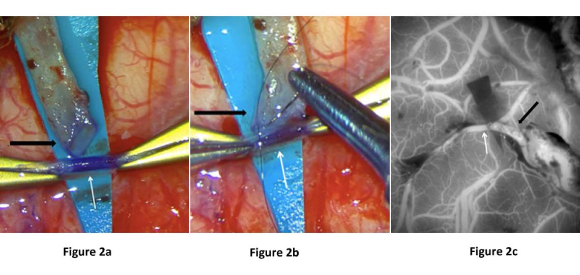 Direct revascularization