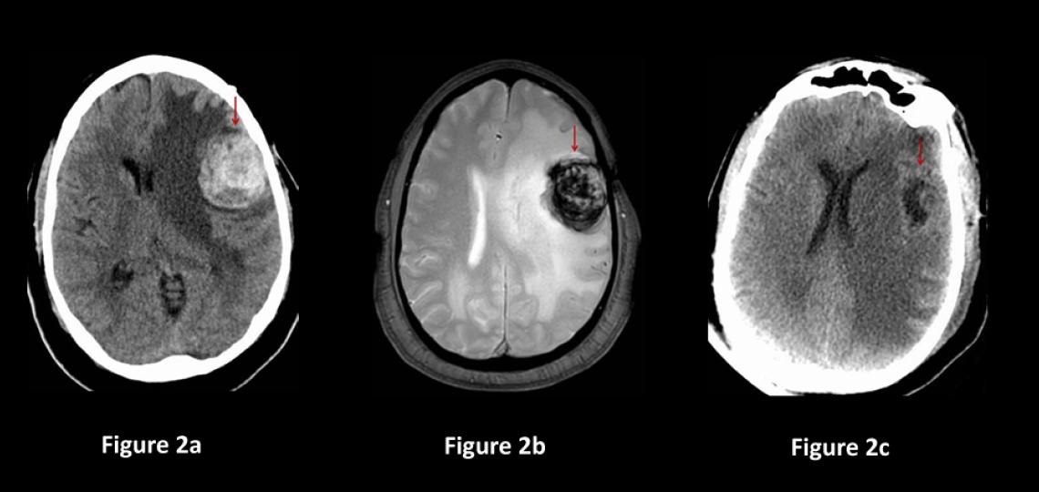 Figure 2. Cavernous Malformations