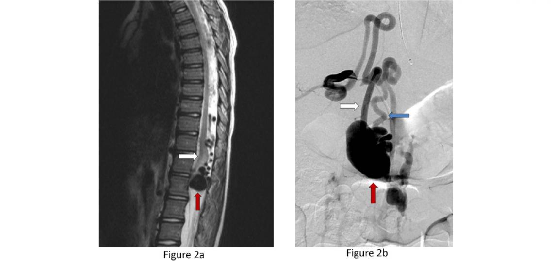 Figure 2. Spinal Vascular Malformation