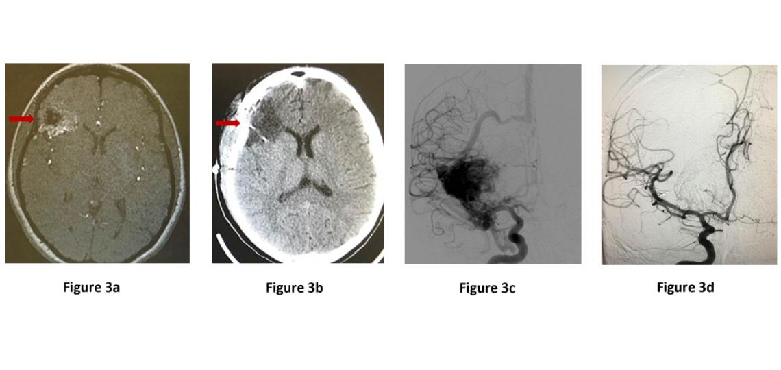 Figure 3. Brain AVM