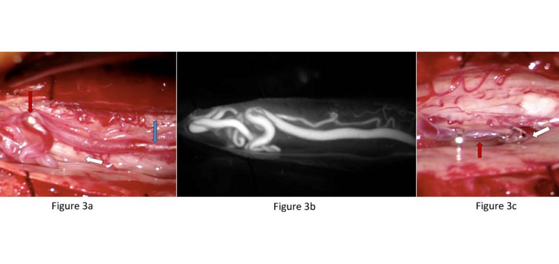 Figure 3. Spinal Vascular Malformation