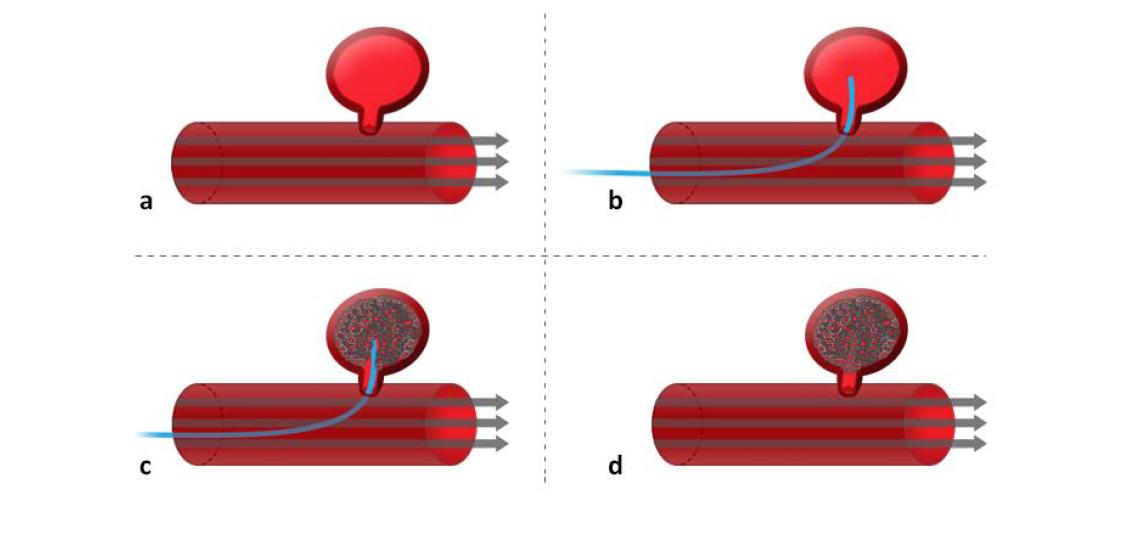 Figure 4. Brain aneurysm coiling