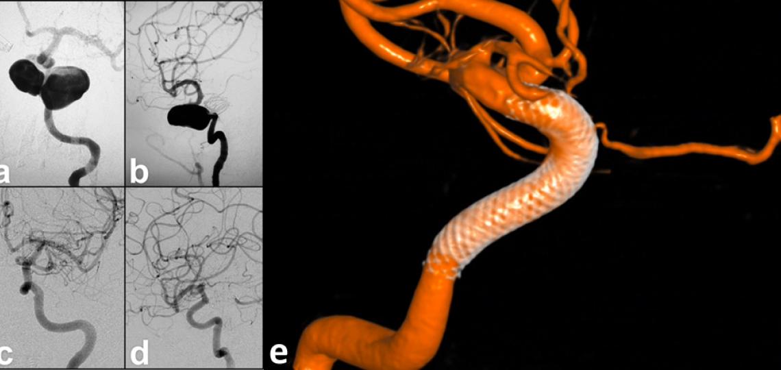 Figure 6. Brain aneurysm