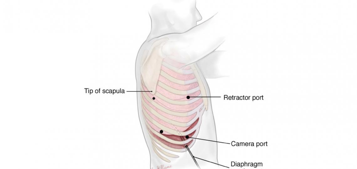 Minimally invasive esophagectomy laparoscopic port sites - courtesy McGraw-Hill