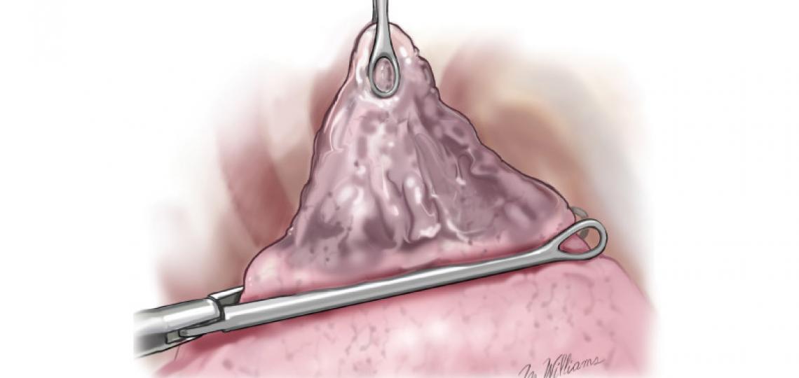 Pulmonary Blebs And Bullae