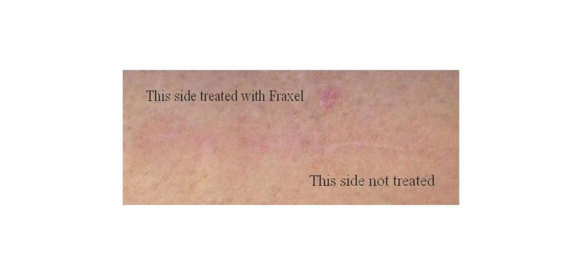 Laser Treatment With Fraxel