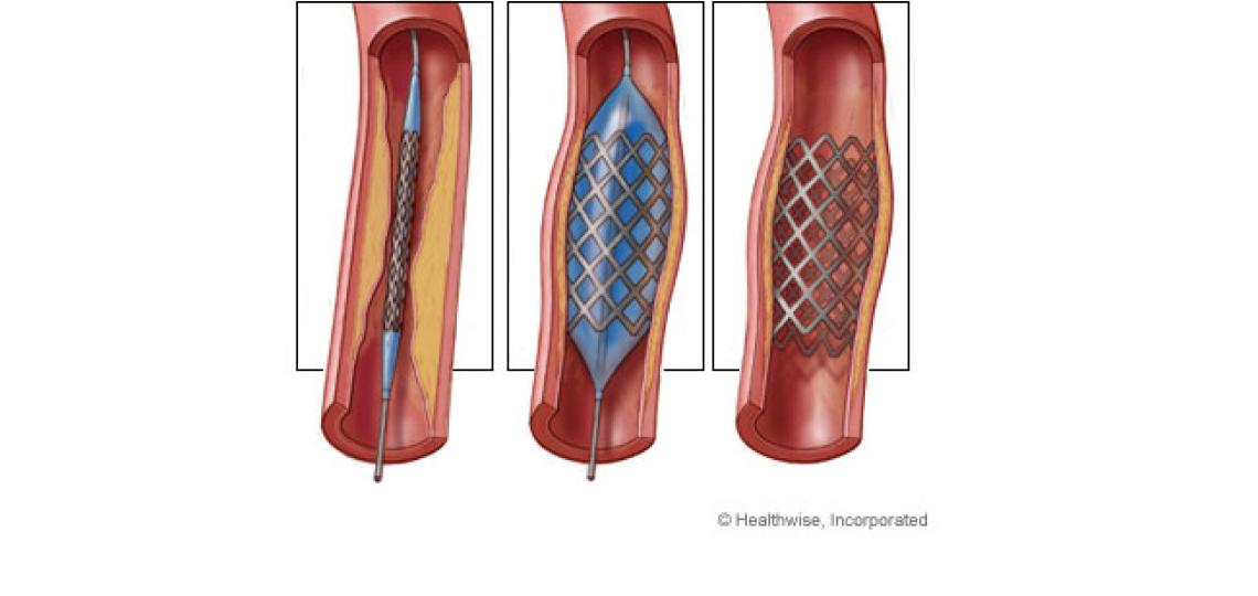 Angioplasty