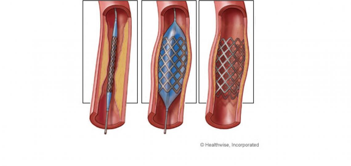 Angioplasty and Stent Placement Angioplasty and Stent Placement
