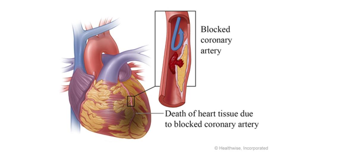 Coronary artery disease