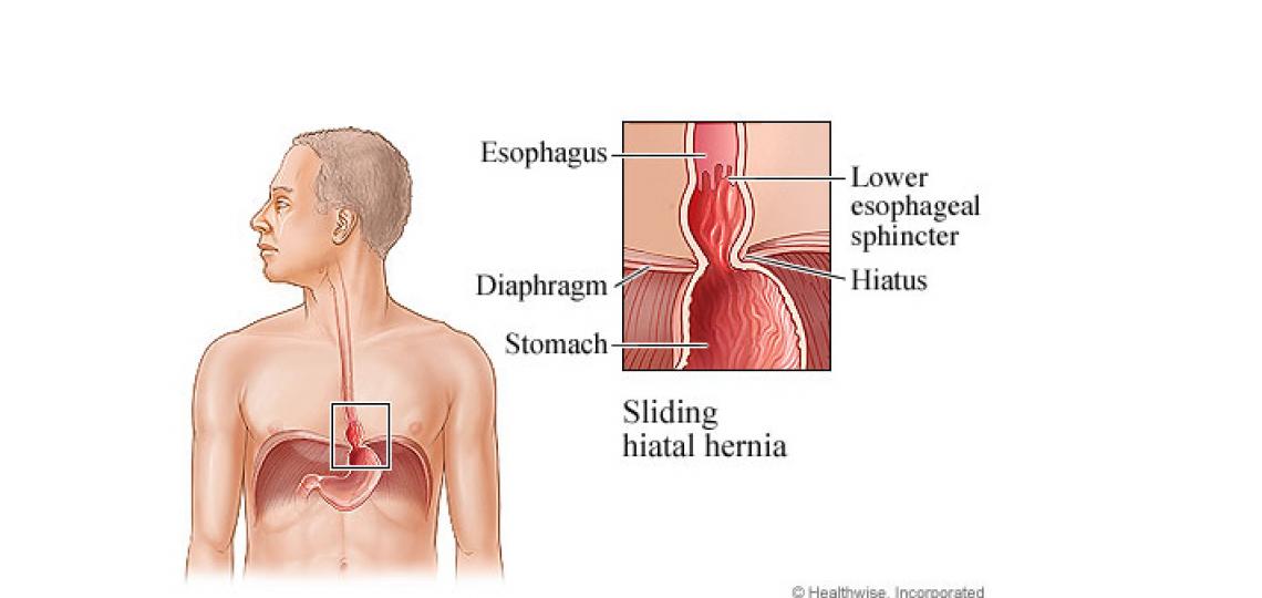 Dieta esofagitis hernia de hiato