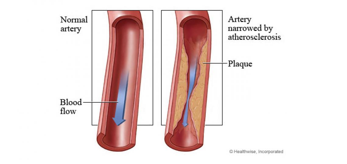 Peripheral artery disease (PAD)