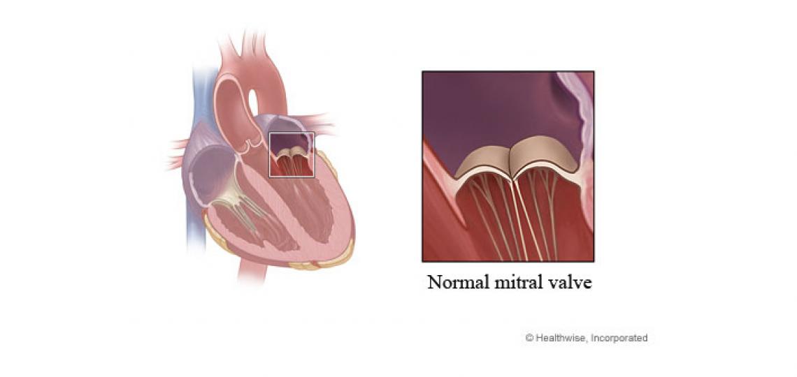 Mitral valve prolapse