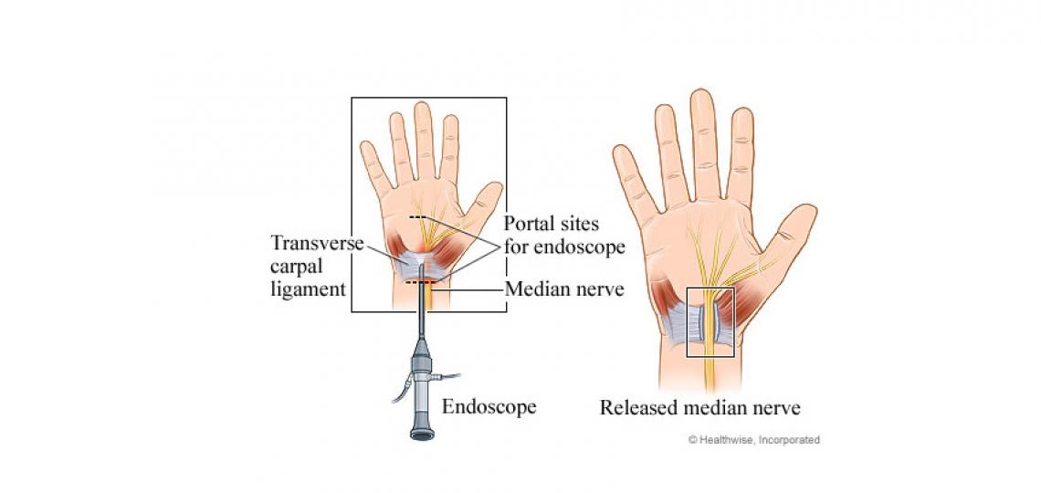 Endoscopic carpal tunnel release