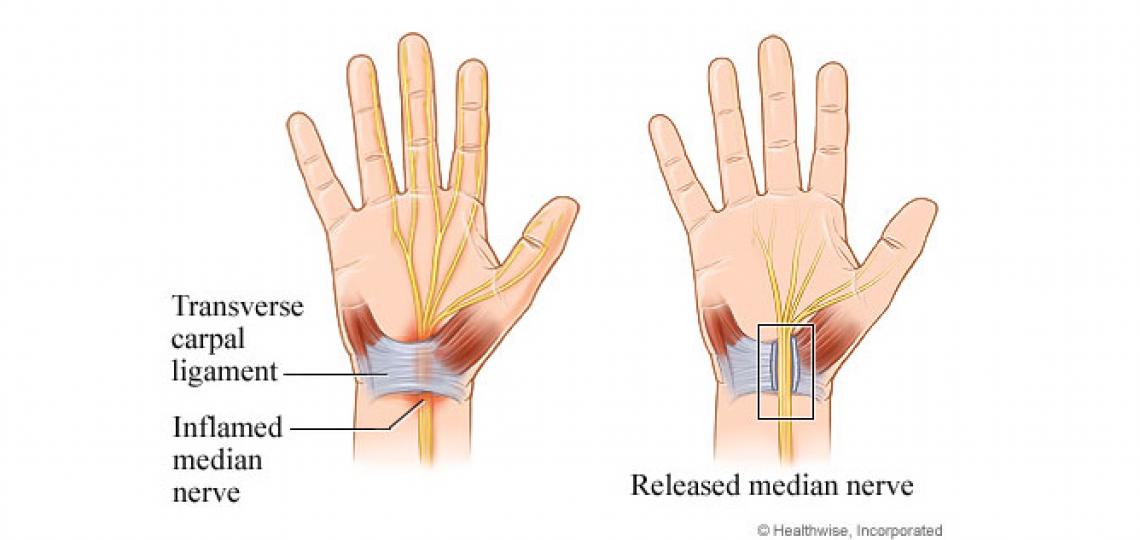 Carpal Tunnel Syndrome