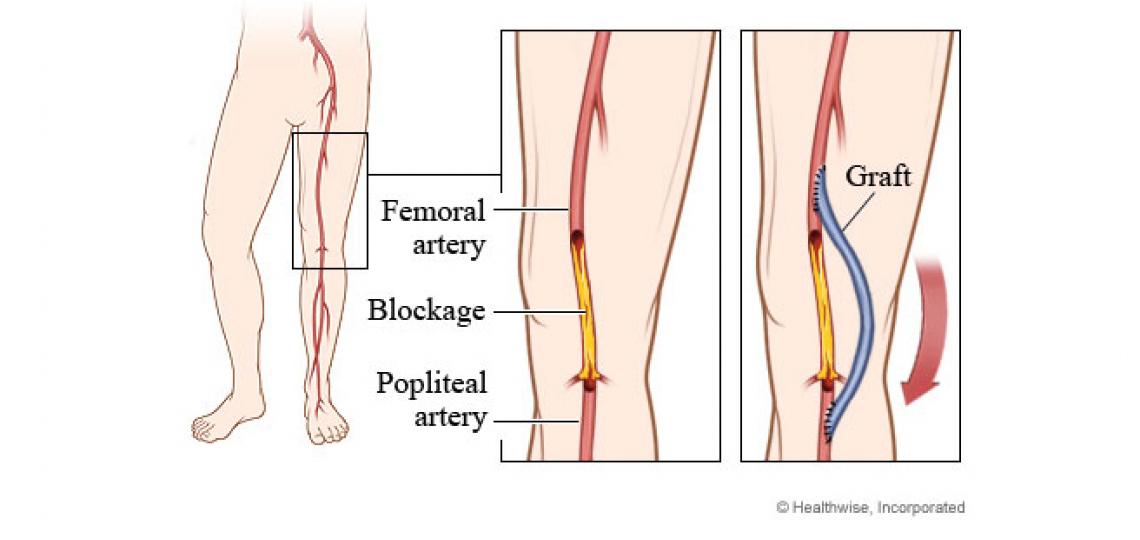 Femoropopliteal (fem-pop) bypass