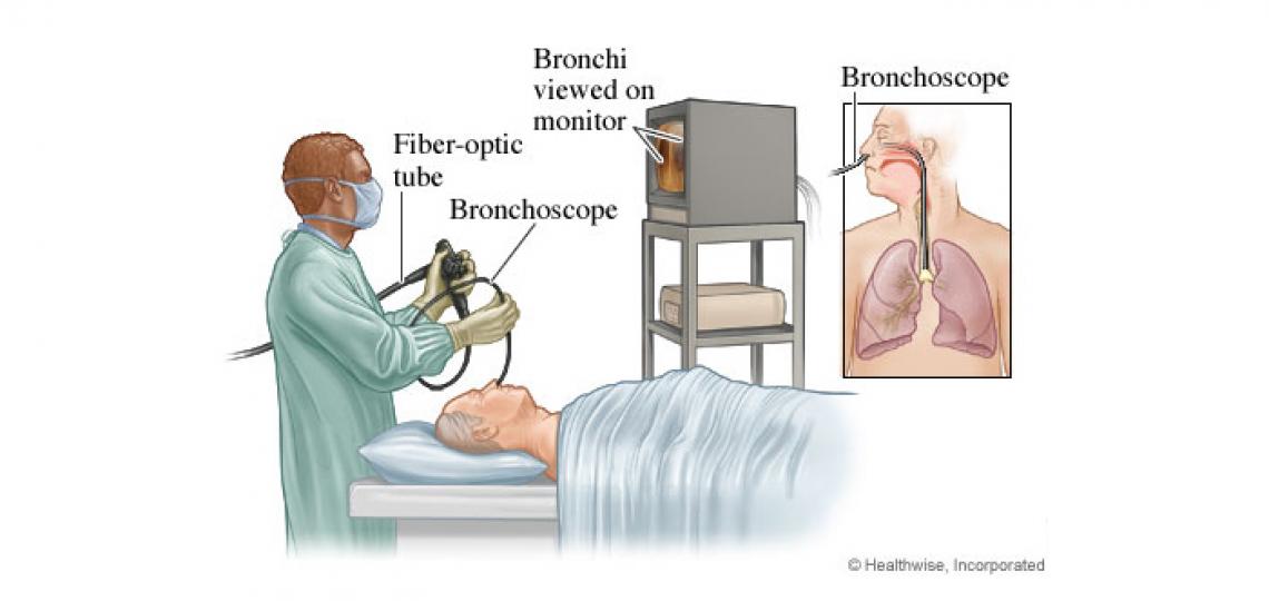 Bronchoscope