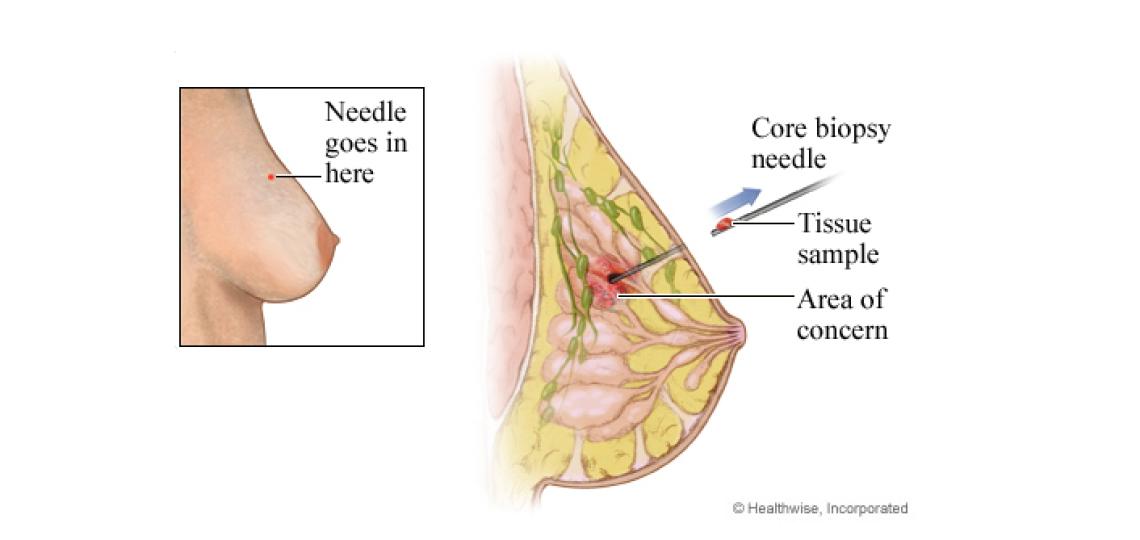 Core needle biopsy