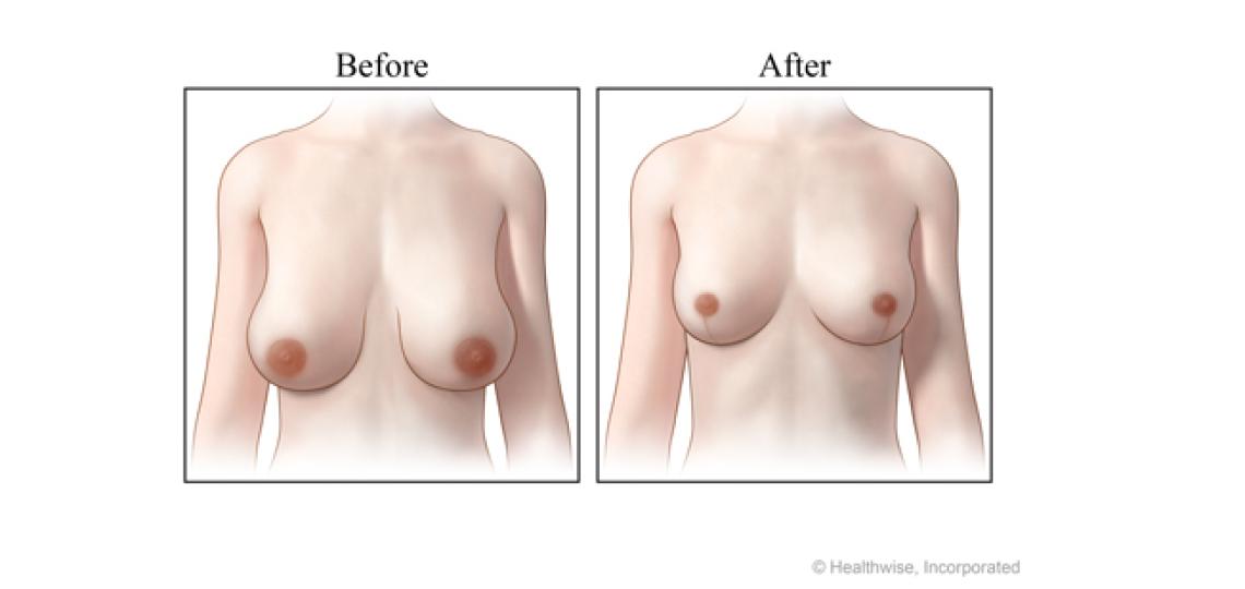 Breast reduction