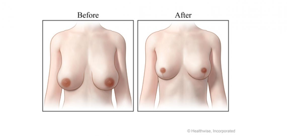 Breast reduction