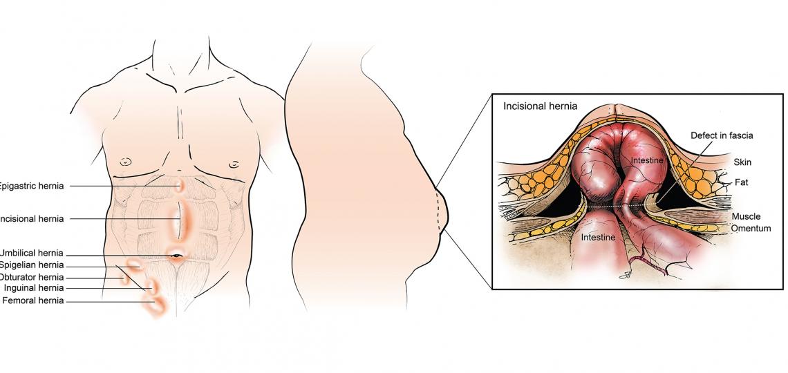 Hernias