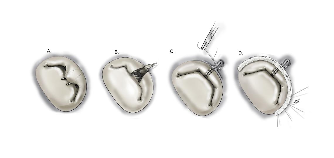 Triangular, posterior mitral valve leaflet repair.