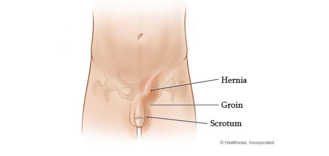 Inguinal hernia