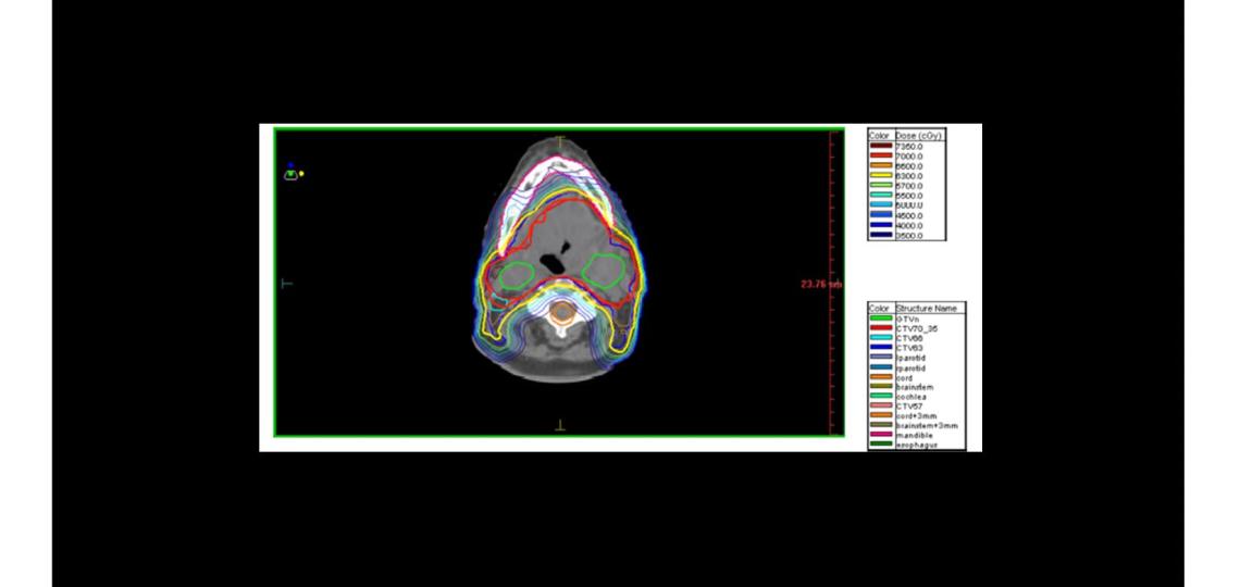 INTENSITY MODULATED RADIATION THERAPY (IMRT) houston texas medical center radiation best