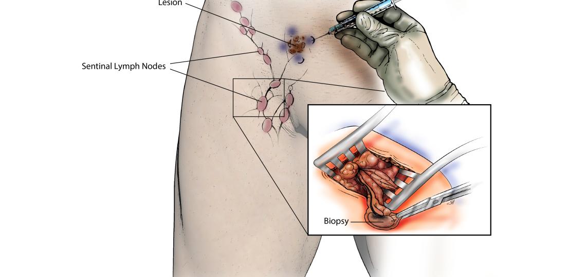 Inguinal sentinel lymph node biopsy