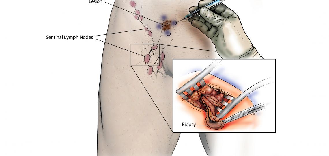 Sentinel Lymph Node Biopsy For Skin Cancer