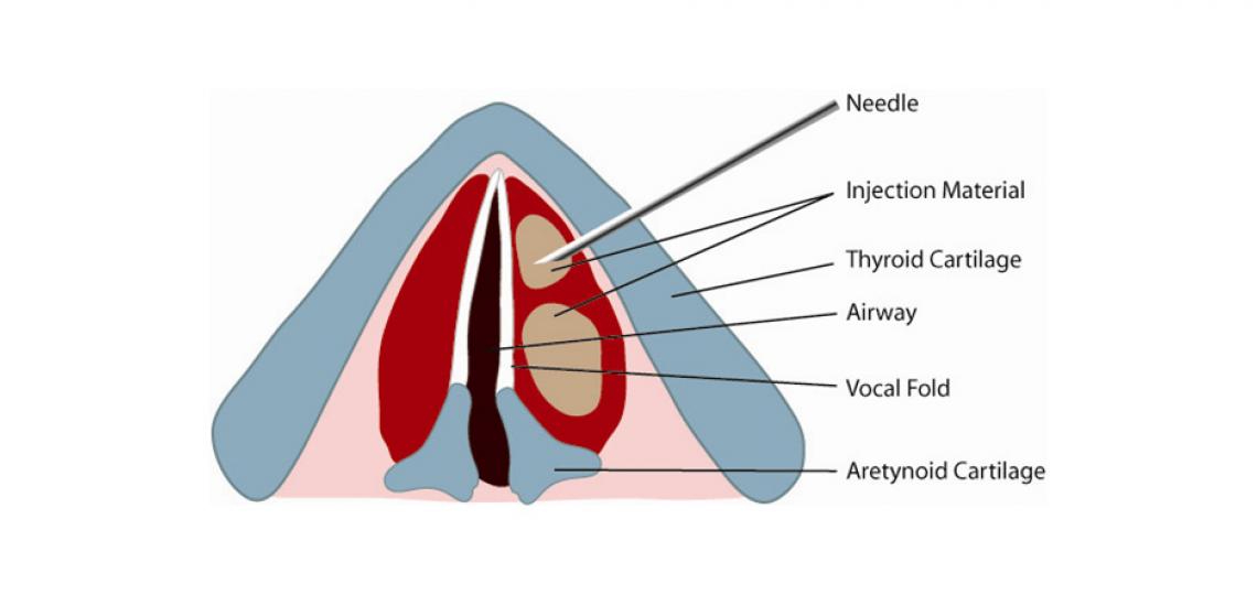 Vocal Fold Paralysis